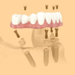 dentadura fixa ou móvel diferenças tratamento