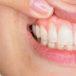 Retração Gengival e Cirurgia com Enxerto de Gengivas. (webstory) retração gengival o que é