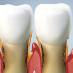 periodontite agressiva o que é