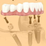 implante dentario sem pontos