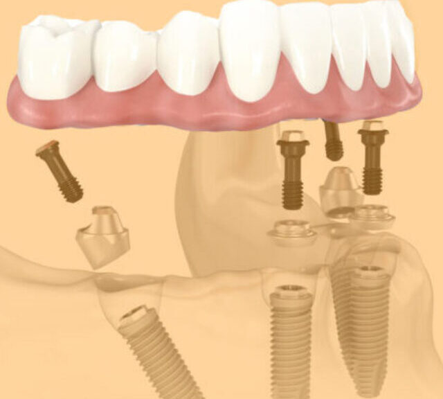 implante dentario sem pontos