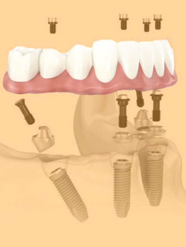 Implantes Dentários Sem Pontos. Mais precisão, conforto e rapidez.