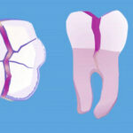 dente movel mole mobilidade frouxo trauma dentário