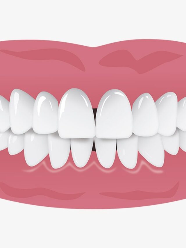 Black Space Gengiva: Como recuperar e prevenir a perda das gengivas entre os dentes.